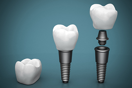 Dental Implants Dental Implants Mills River NC-Mills River Family Dental
