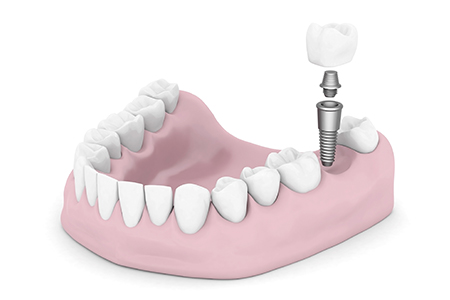 Dental Implants Mills River NC
