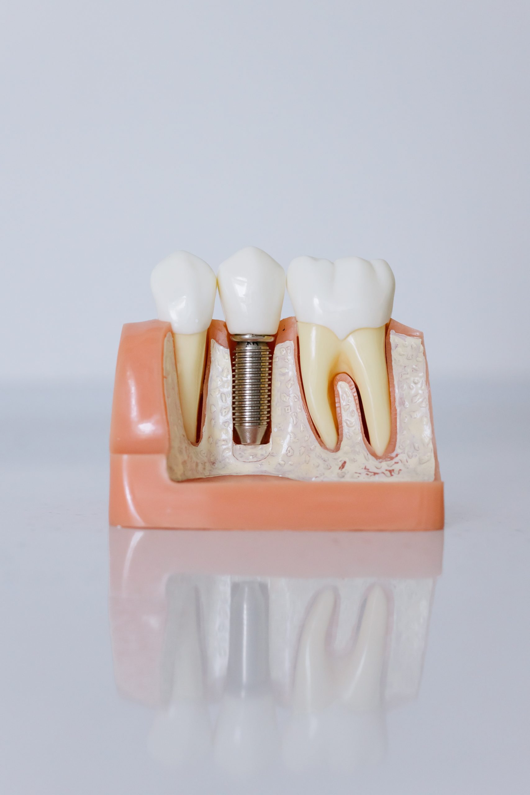 Tips for Taking Care of your Dental Implants Tips for Taking Care of your Dental Implants