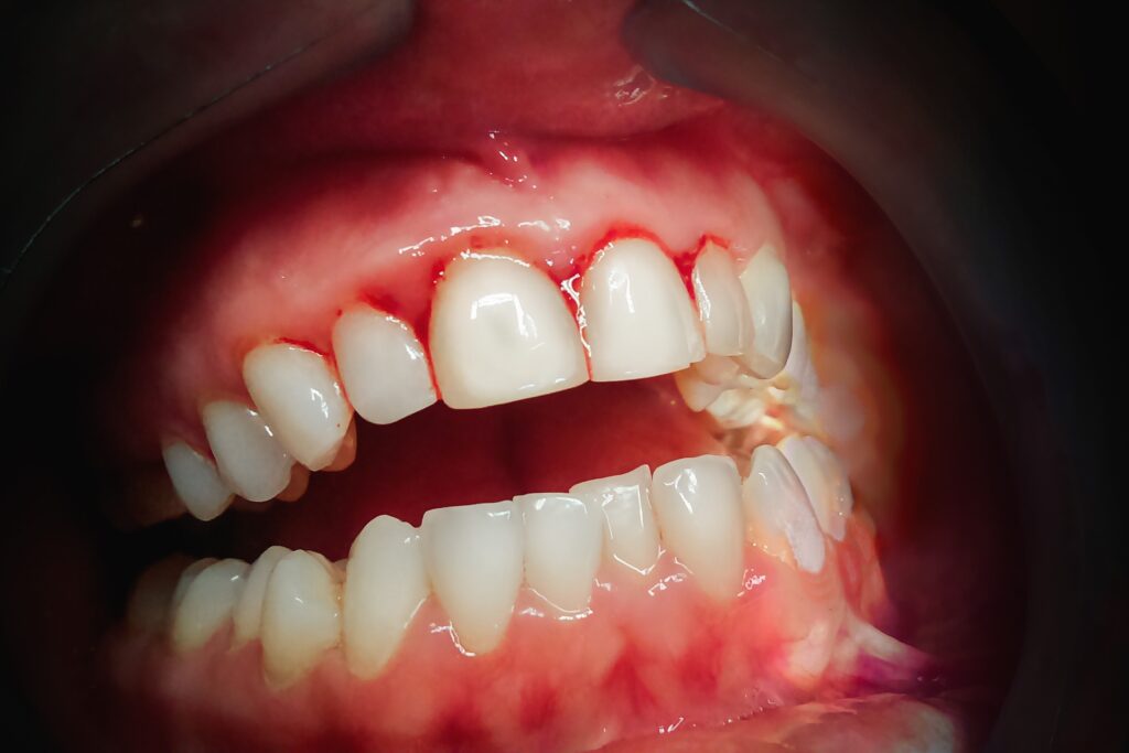 3+ Important Facts About Gingivitis Gingivitis in Mills River, NC