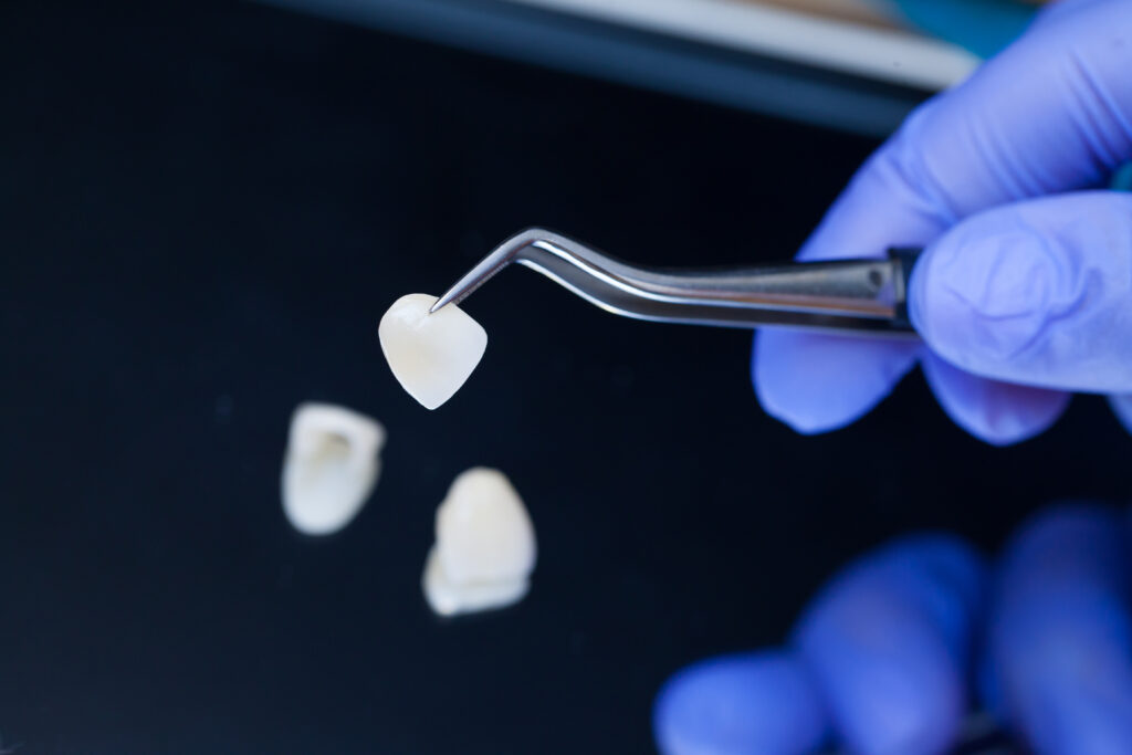 Are You Getting Veneers? Here’s Everything You Should Consider Before Making The Investment Getting veneers