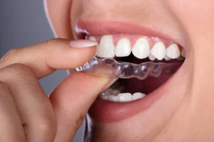Are Clear Aligners Better Than Traditional Braces?