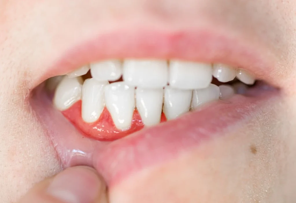 Why Do You Have Receding Gums? Receding Gums - Mills River Family Dental, Mills River, NC